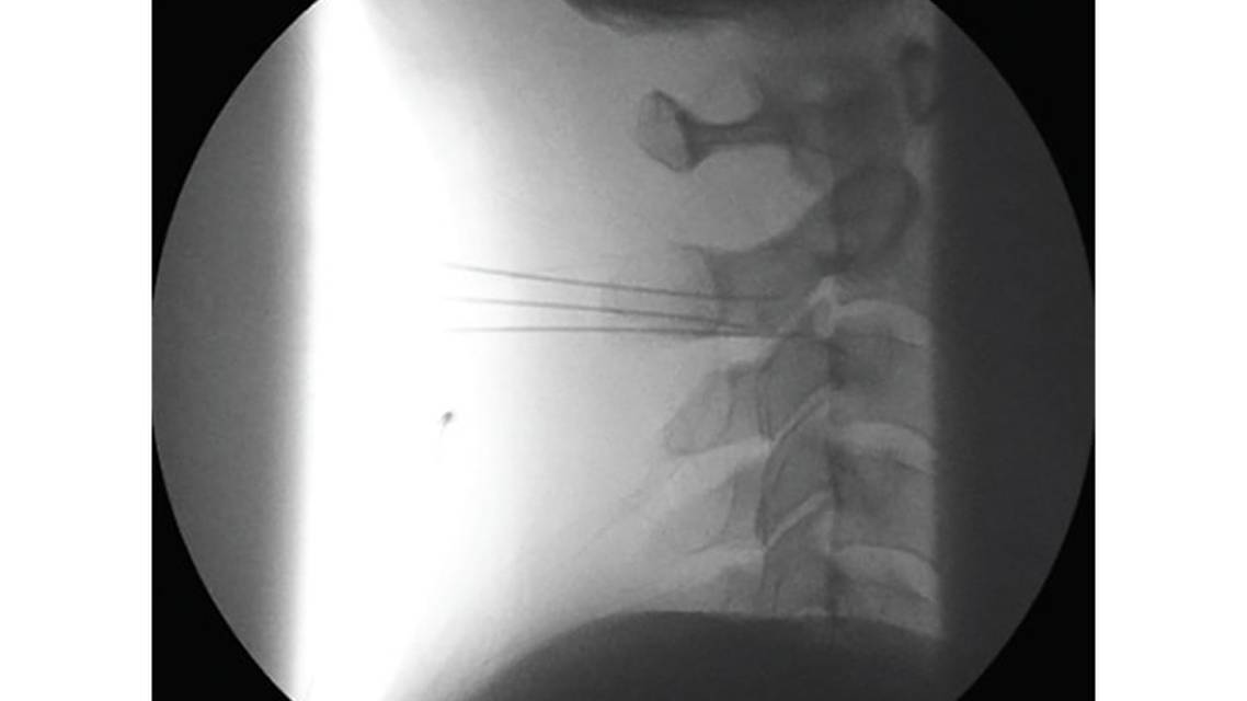 Occipital Neuralgia and Cervicogenic Headache