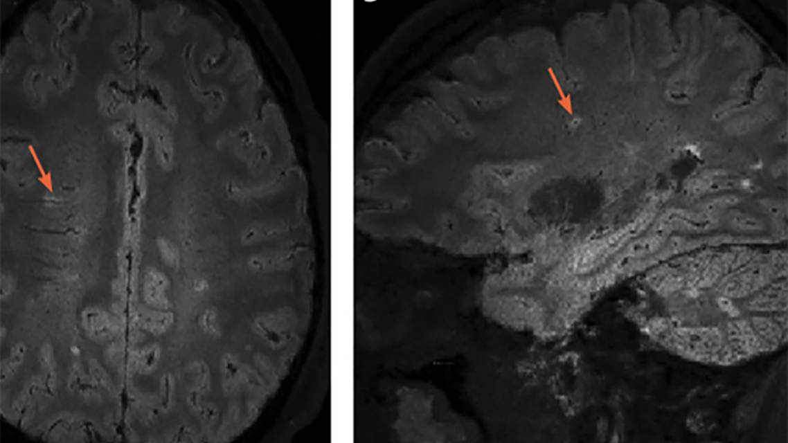 Multiple Sclerosis Minute The Central Vein Sign in Diagnosis of Multiple Sclerosis