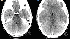 Case Report Noninvasive Intracranial Pressure Monitoring