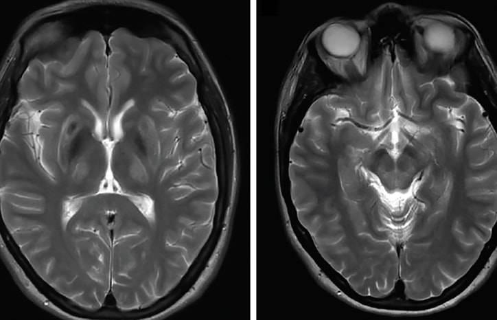 Wilson Disease