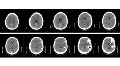 Management of Vein of Galen Thrombosis With Mechanical Thrombectomy