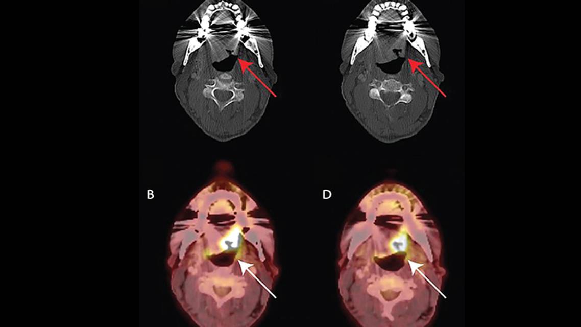 Glossopharyngeal Neuralgia
