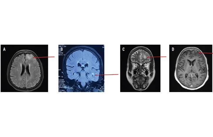 LGI1 Antibody Encephalitis Presenting as Focal Cortical Encephalitis