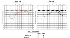 Acute Onset Weakness Deafness and Confusion A Case of Multisystem Thiamine Deficiency