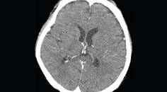 Eosinophilic Meningitis After Eating Freshwater Snails