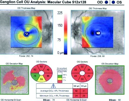 Gcipl Paraclinical Optic Nerve Tests in Multiple Sclerosis