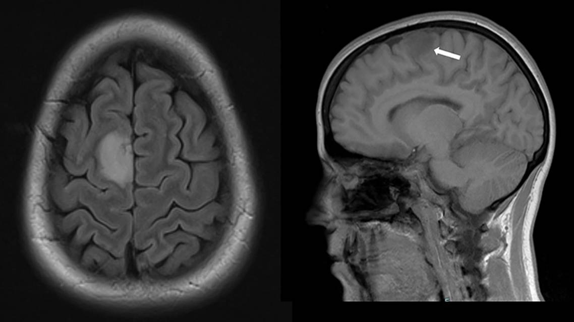 Supplementary Motor Area Glioma Presenting with Musicogenic Epilepsy Singing Seizures