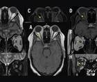 Neuro Ophthalmology Notions The Optic Nerve as Topographic Marker in the 2024 McDonald Diagnostic Criteria for Multiple Scle