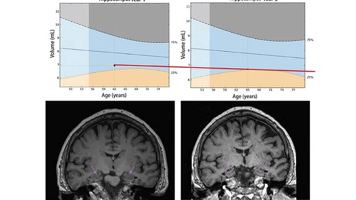 Quantitative Structural MRI for Neurocognitive Disorders