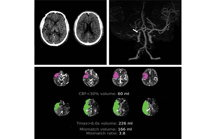 Stroke Snapshot Endovascular Thrombectomy for Stroke Treatment Outside the Established Criteria for Efficacy