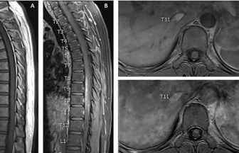 Neuroschistosomiasis