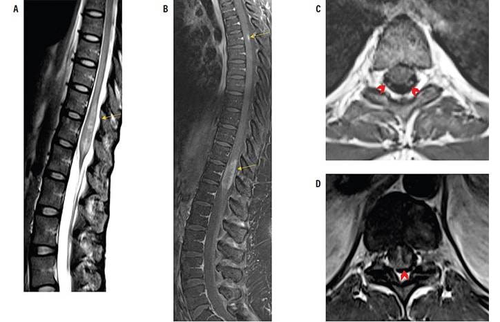 Neuromyelitis Optica Spectrum Disorder With Atypical Imaging Features