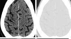 Stroke Snapshot Stroke Due to Hemodialysis Associated Air Embolism