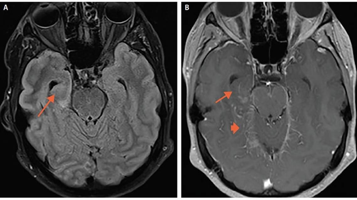 Case Report Seizure Fever Hallucinations and Vision Loss