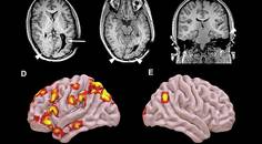 Neurostimulation in Drug Resistant Epilepsy