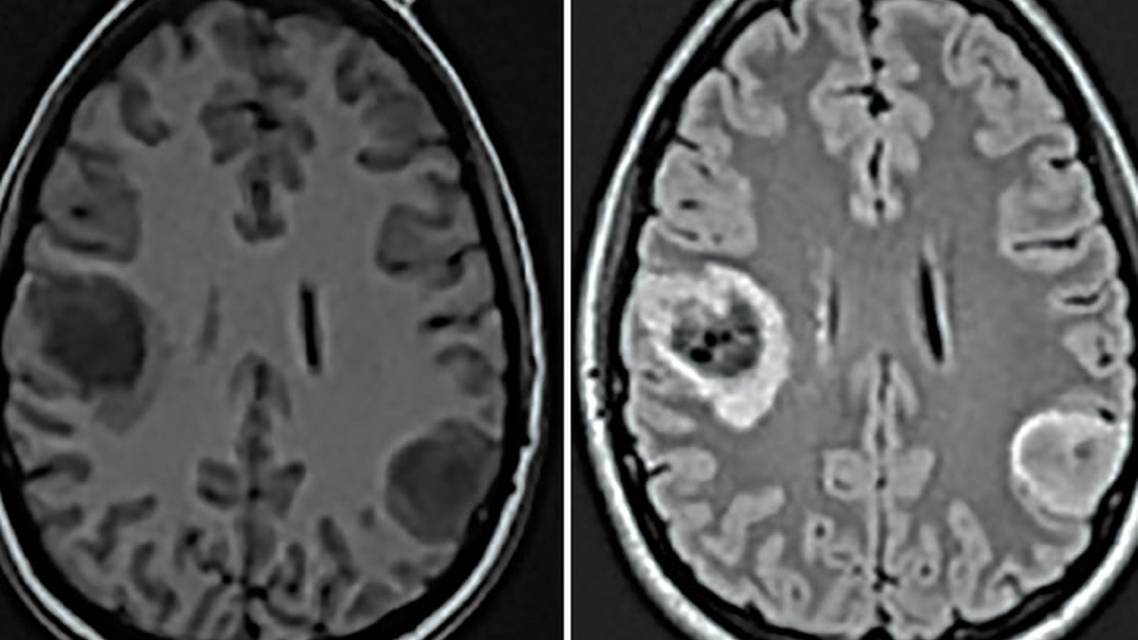 Challenge Case Report New Onset Seizures and Brain Lesions in First Trimester