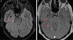 Case Report Seizure Fever Hallucinations and Vision Loss