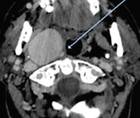 An Unusual Presentation of Syncope in a Patient With a Giant Cervical Carotid Aneurysm
