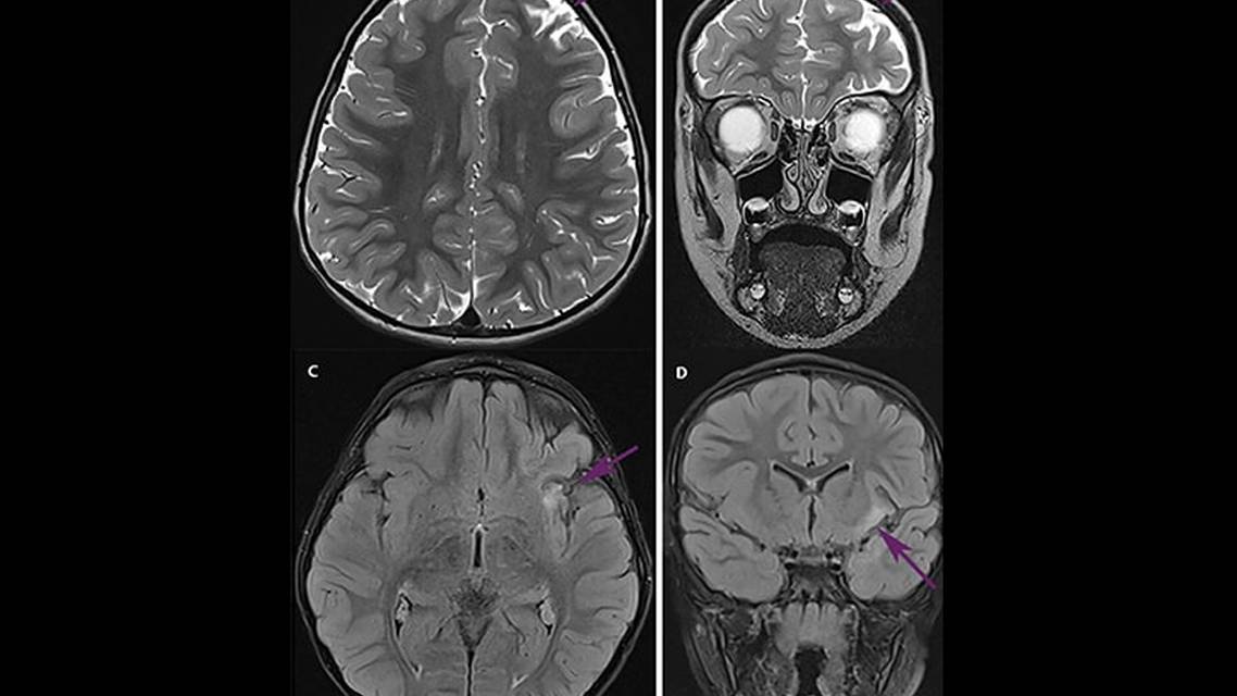 Progressive Drug Resistant Epilepsy and Behavior Changes