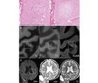 Stroke Snapshot Cerebral MicroinfarctsEtiology and Clinical Implications of This Novel MRI Marker