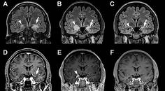 Autoimmune Associated Epilepsy