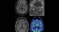 Critical Bilateral Carotid Artery Disease Presenting as Hemichorea