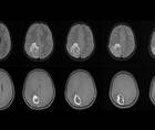 Focal Status Epilepticus 9 Years After Brain Abscess