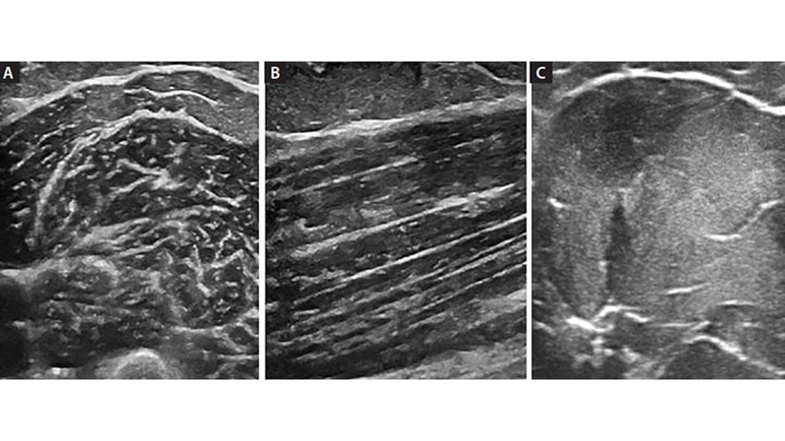 Ultrasound in Neuromuscular Medicine