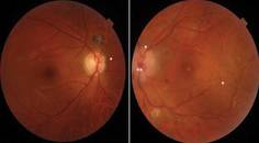 Cytomegalovirus and Herpes Simplex Virus Coinfection Neuroretinitis in an Immunocompetent Individual