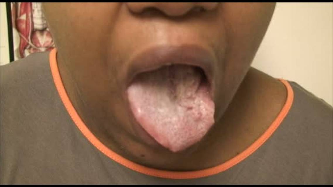 Tinnitus and Otalgia in a 41 year old Woman