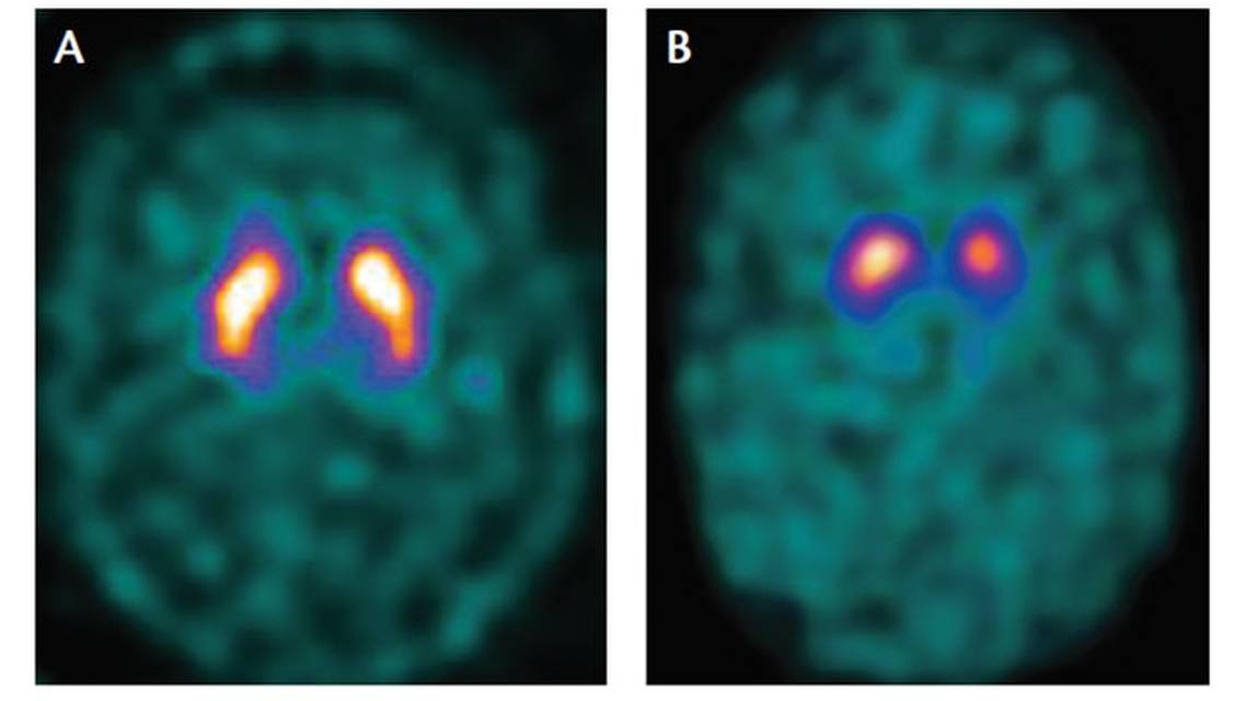 Imaging in Parkinsons Disease