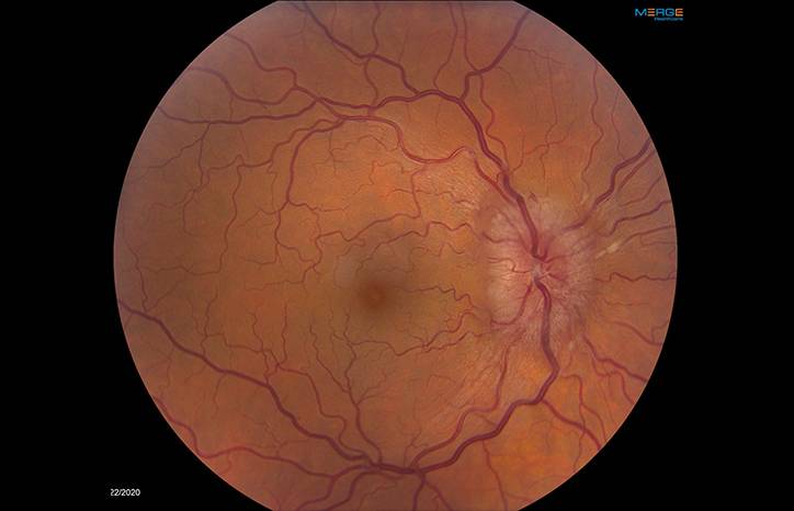 Pseudotumor Cerebri Syndrome Related to a Dural Arteriovenous Fistula After Vascular Trauma