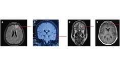 LGI1 Antibody Encephalitis Presenting as Focal Cortical Encephalitis