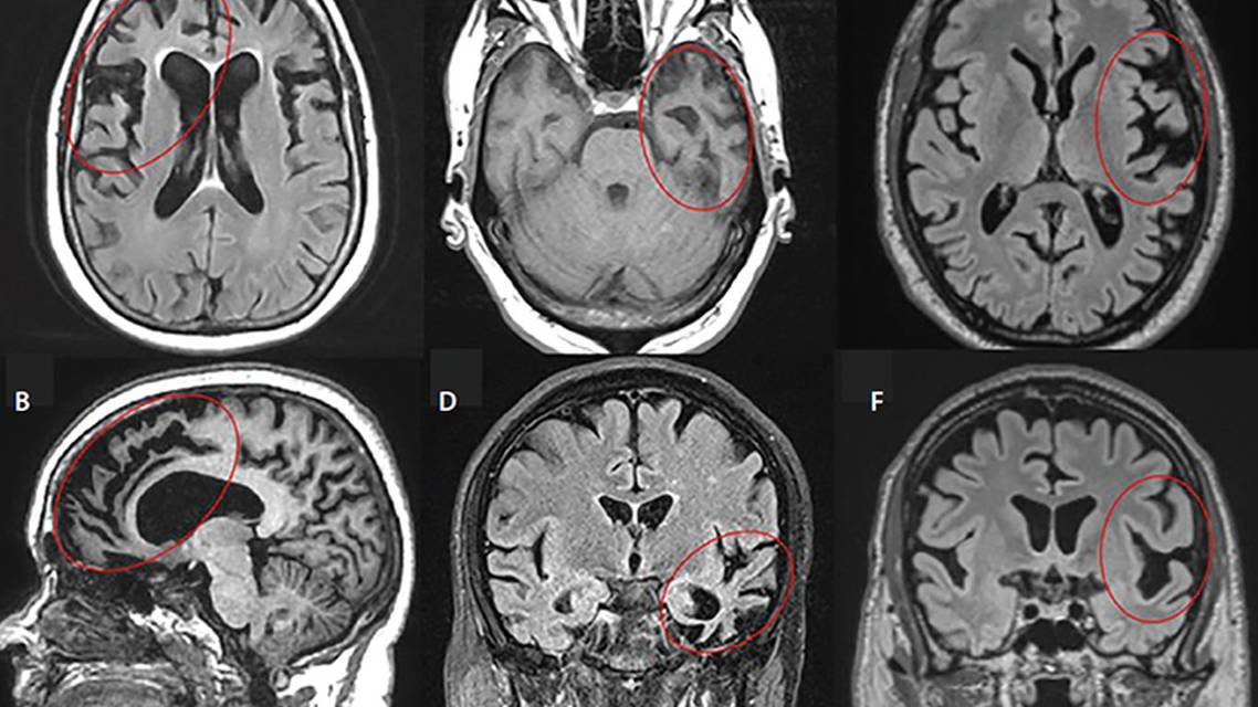 Frontotemporal Dementias