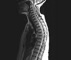 Case Report Longitudinally Extensive Transverse Myelitis