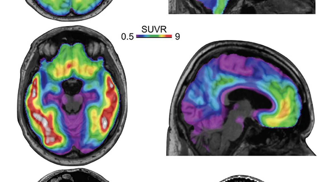 Alzheimers Disease Biomarkers