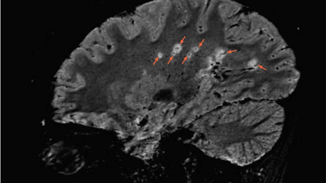 An Example of the Central Vein Sign