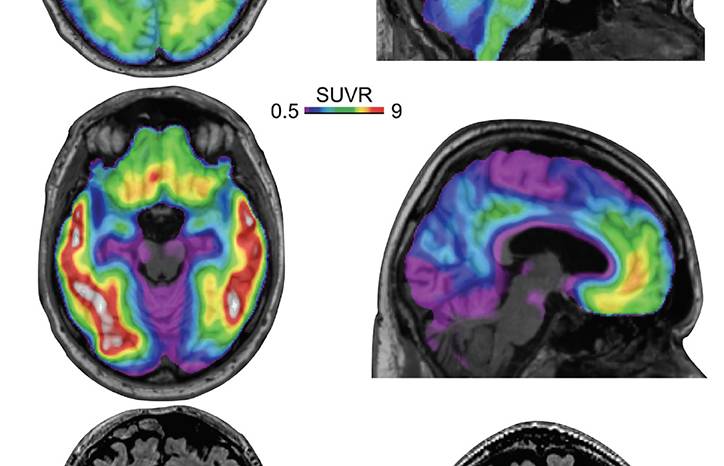 Alzheimers Disease Biomarkers