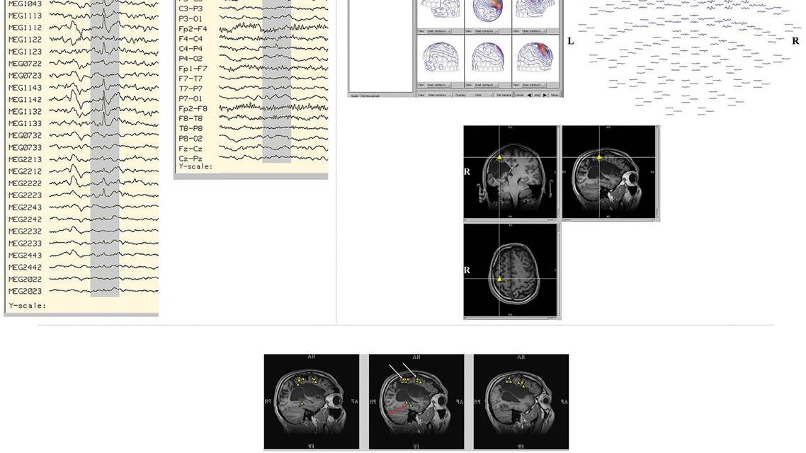 Epilepsy Essentials Application of Magnetoencephalography in the Diagnosis and Treatment of Epilepsy