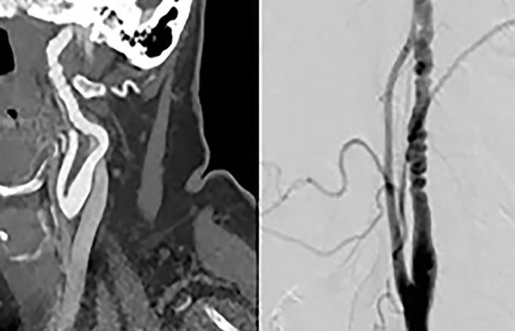 Unusual Causes of Stroke