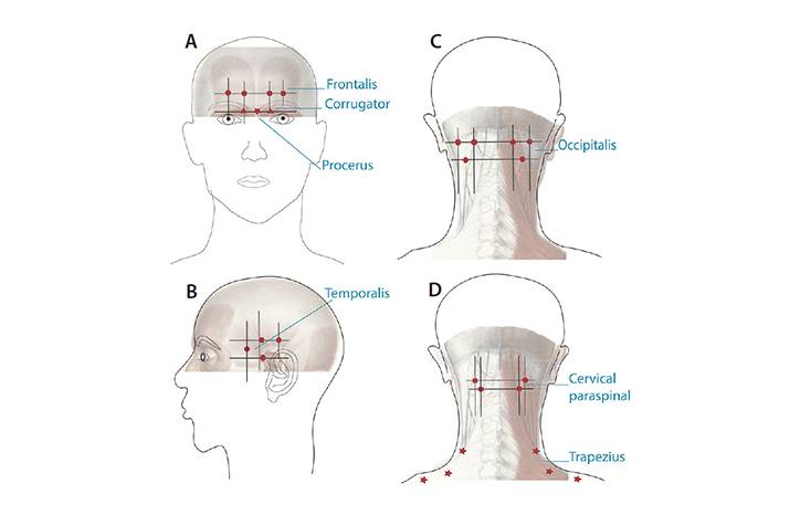 Procedural Treatments for Headache Disorders