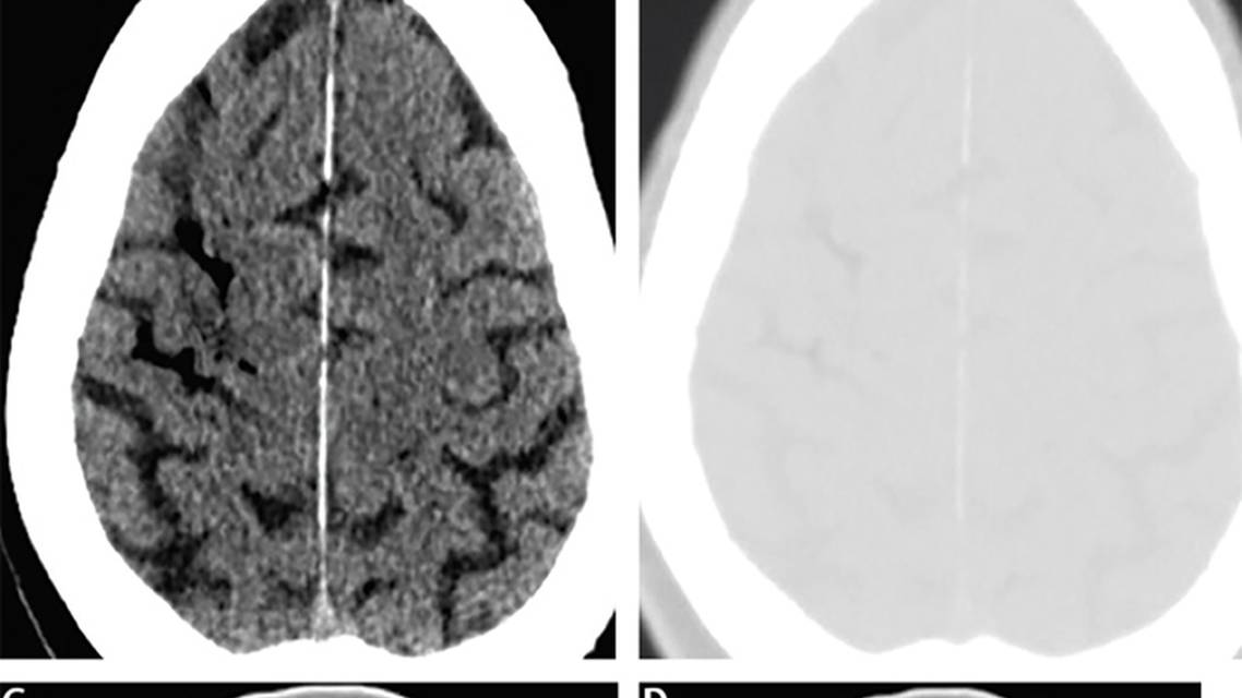 Stroke Snapshot Stroke Due to Hemodialysis Associated Air Embolism