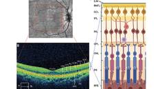 MS Minute Retinal Optical Coherence Tomography for MS