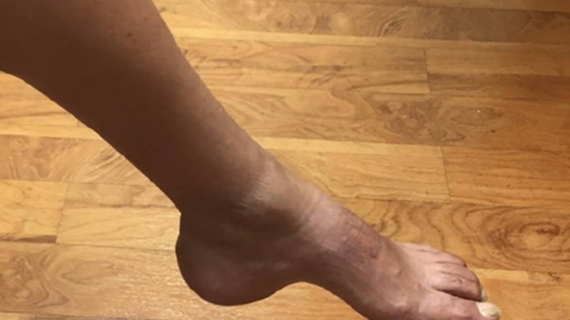 Challenge Case Report Weakness and Wasting of the Left Foot With Pes Cavus