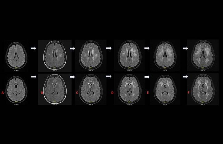 An Unusual Case of Adult Onset Rapidly Progressive Leukoencephalopathy Associated With POLR3B Related Sequence Variati