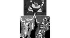 Bilateral Vertebral Artery Dissection and Occlusion After a Long Distance Open Water Swim