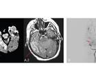 Neurologic Complications of Globally Prevalent Infectious Disorders A Focus on Syphilis Cysticercosis and Tuberculosis