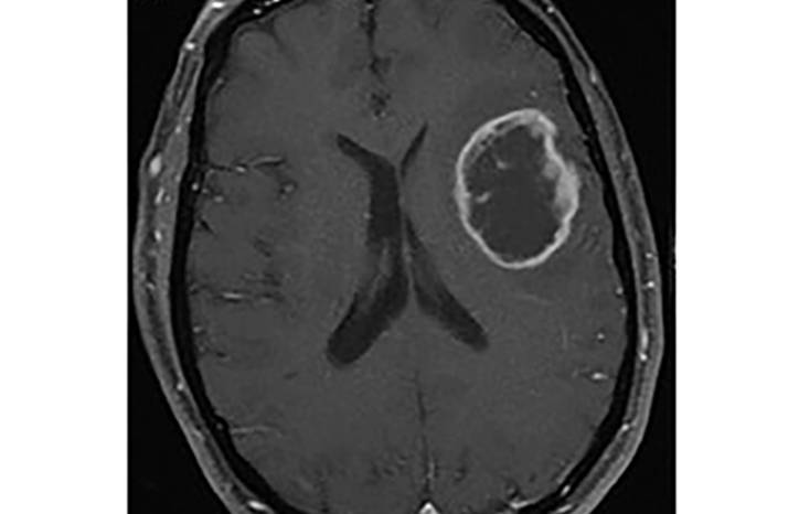 Challenge Case Report Subacute Cognitive Decline