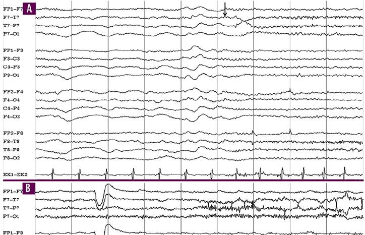 Epilepsy Essentials VideoEEG Analysis