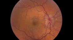 Pseudotumor Cerebri Syndrome Related to a Dural Arteriovenous Fistula After Vascular Trauma